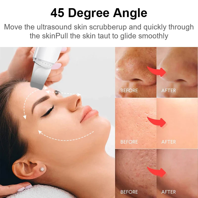 Ultrasonic Skin Scrubber Pro